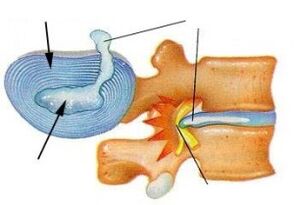 Distruzione dell'anello fibroso con osteocondosi cervicale