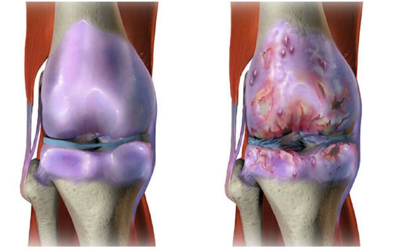 cartilagine sana e distruzione dell'articolazione del ginocchio con osteoartrite