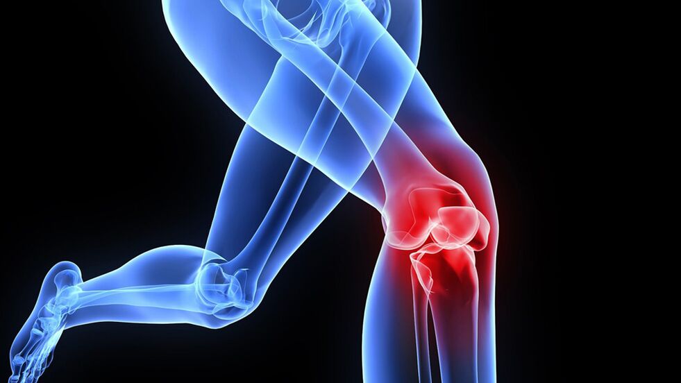 Problemi al ginocchio dovuti all'artrosi