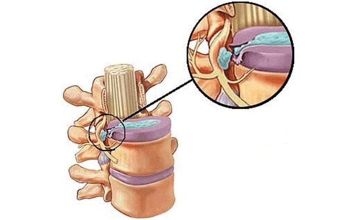 Ernia intervertebrale con osteocondrosi toracica